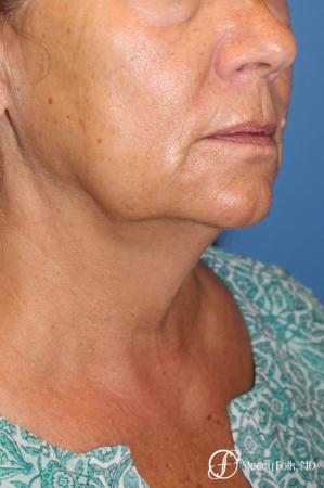 Denver Facial Rejuvenation Face Lift, Fat Injection, Laser Resurfacing 7123 - Before Image 2