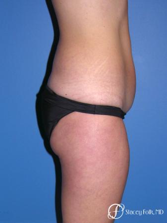 Denver Tummy Tuck Abdominoplasty and liposuction 4880 - Before and After Image 3