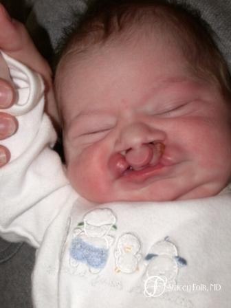 Denver Cleft Lip and Palate Repair 963 - Before
