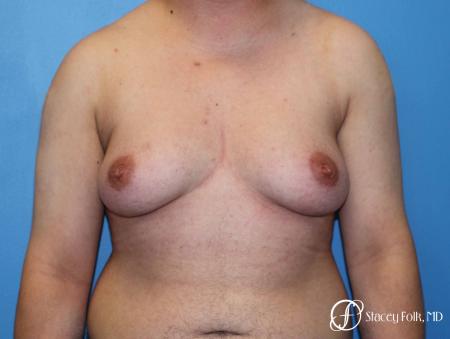 Denver FTM Top Surgery 5089 - Before Image 1