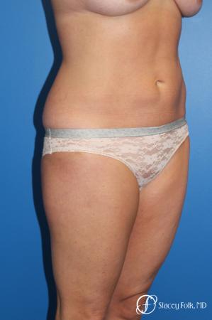 Denver Liposuction 10267 - Before and After Image 3