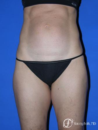 Denver Tummy Tuck Abdominoplasty 5485 - Before Image 1