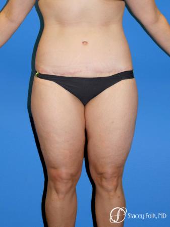 Denver Body Lift Belt lipectomy & liposuction 5264 - After Image 1
