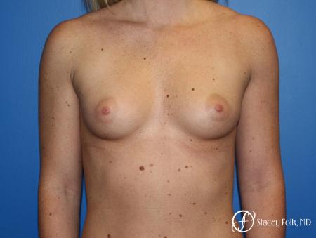 Breast Augmentation with Sientra Textured Implants - Before Image 1