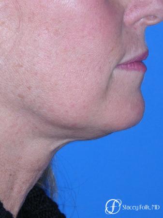 Denver Facial Rejuvenation 7916 - Before and After Image 2