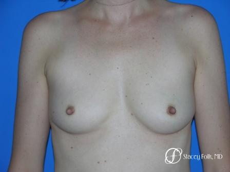 Denver Breast Augmentation 9 - Before Image 1