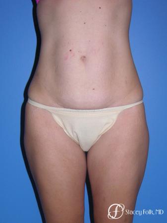 Denver Tummy Tuck (Abdominoplasty) 4782 - Before Image 1