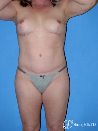 Denver Tummy Tuck 4783 - After Image 1