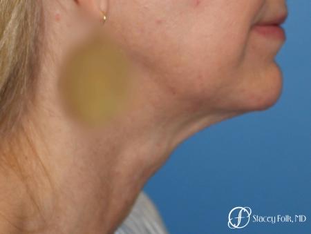 Denver Facial Rejuvenation Face Lift and Fat Injections 7126 - Before Image 1