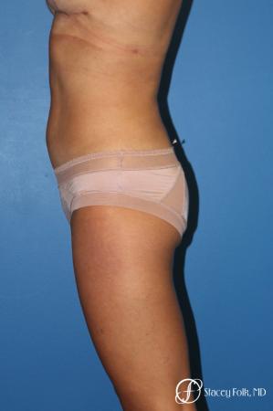 Liposuction - After Image 2
