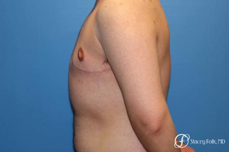 Denver FTM Top Surgery 5089 - After Image 2