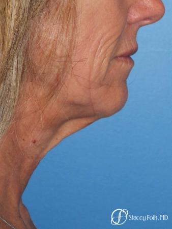 Denver Facial Rejuvenation Face lift, Fat Injections, and Laser Resurfacing 7132 - Before Image 1