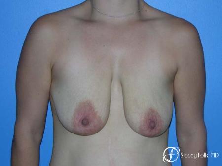 Denver Breast Lift - Mastopexy 7981 - Before Image 1