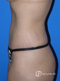 Denver Tummy Tuck 19 - After Image 2