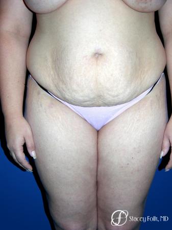Denver Tummy Tuck 23 - Before Image 1