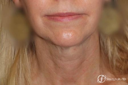 Denver Facial Rejuvenation Face Lift and Fat Injections 7126 - Before and After Image 3