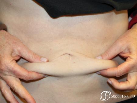 CoolSculpting®: Patient 7 - After Image 1