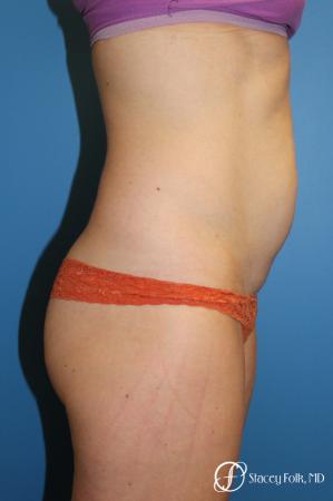 Denver Tummy Tuck - Abdominoplasty 8266 - Before Image 2