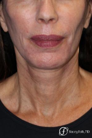 Facelift, Fat Transfer, Laser - After Image 2