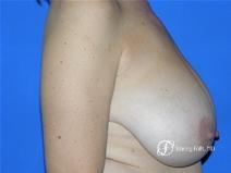 Denver Breast Reduction 15 - Before and After Image 3