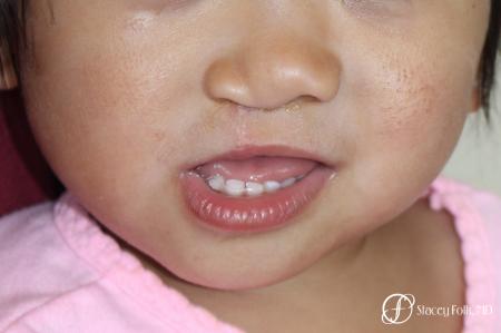 Denver Cleft Lip and Palate Repair 10315 - After Image 1