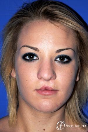 Denver Septorhinoplasty and Cleft Lip Repair 8162 - Before Image 1