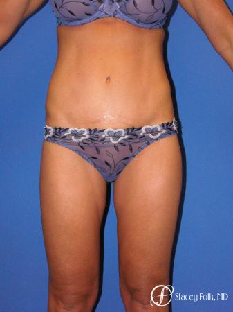 Denver Tummy Tuck - Abdominoplasty 53 - After Image 1
