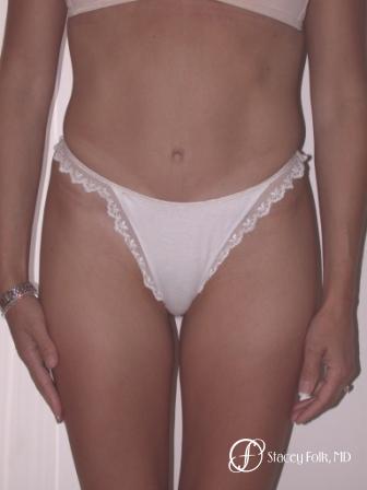 Denver Tummy Tuck 22 - After Image 1