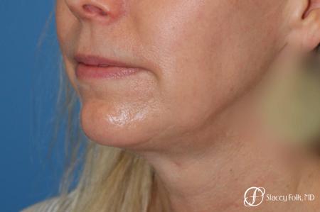 Denver Facial Rejuvenation Face Lift and Fat Injections 7126 - Before Image 2