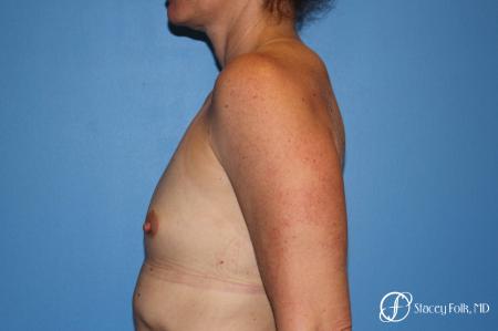 Denver Breast Augmentation 6611 - Before and After Image 3