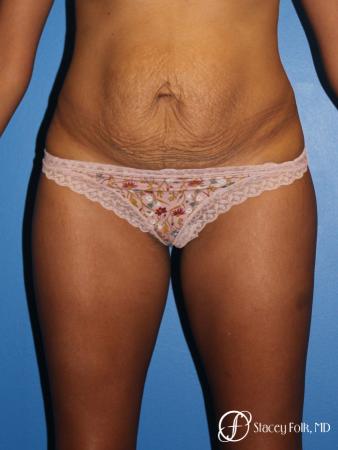 Tummy Tuck (Abdominoplasty) - Before Image 1