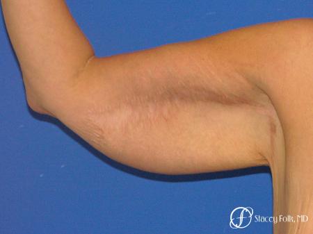 Denver Brachioplasty 8467 - Before and After Image 2