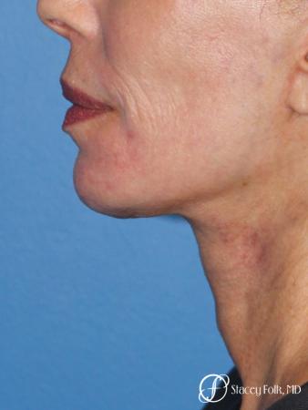 Facelift, Fat Transfer, Laser - After Image 1