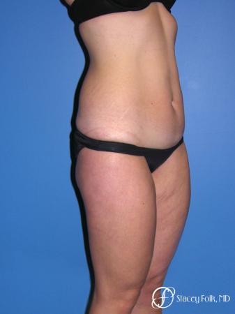 Denver Tummy Tuck Abdominoplasty and liposuction 4880 - Before Image 2
