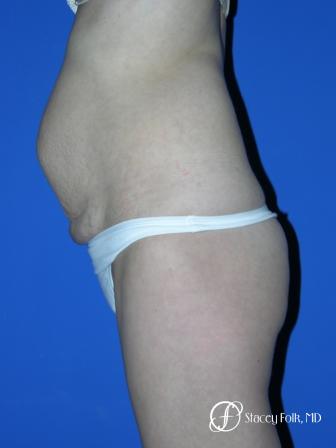 Denver Tummy Tuck 20 - Before and After Image 2