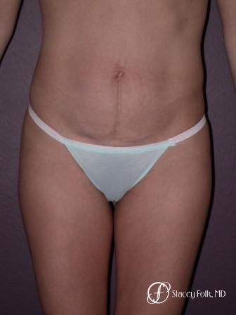 Denver Tummy Tuck 22 - Before Image 1
