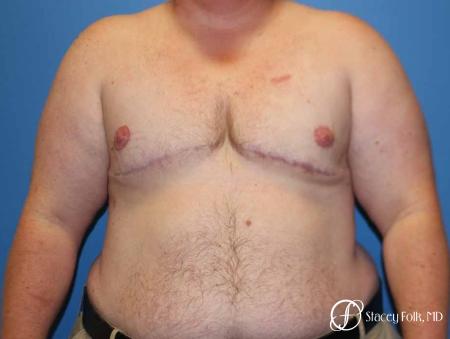Denver Female to male top surgery 5258 - After Image 1