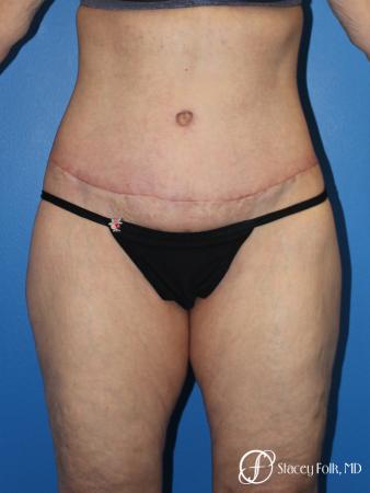 Denver Body Lift 10301 - After Image 1