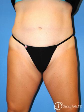 Denver Coolsculpting 8157 - After Image 1