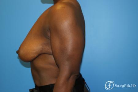 Denver Breast Lift - Mastopexy 7509 - Before and After Image 5