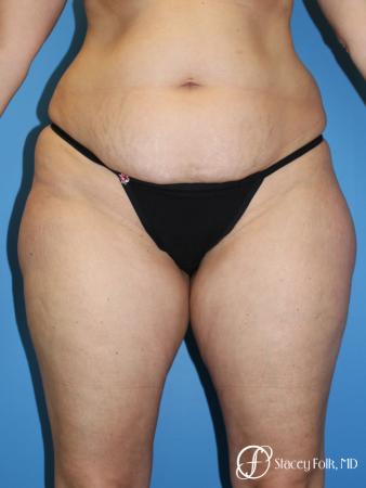 Tummy Tuck - Abdominoplasty - Before Image 1