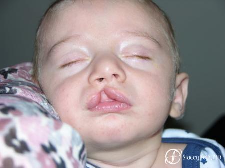 Denver Cleft Lip and Palate Repair 3304 - Before Image 1