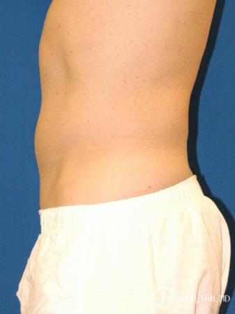 Denver Coolsculpting 5970 - After Image 3