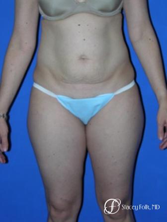 Denver Tummy Tuck 35 - Before Image 1