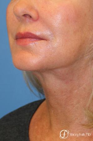 Denver Facelift & Laser Resurfacing 8277 - After Image 2