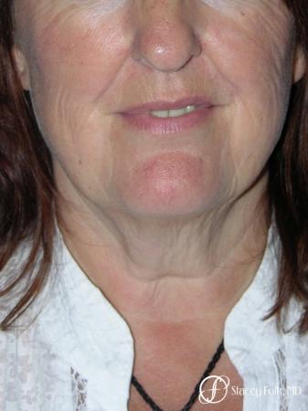 Denver Facial Rejuvenation Face lift, Fat Injections, Laser Resurfacing 7133 - Before and After Image 3