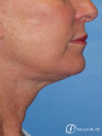 Denver Facial Rejuvenation 7916 - After Image 2
