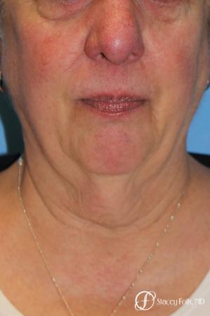 Denver Facial Rejuvenation Face and Neck Lift with Fat Transfer to the Face 9133 - Before and After Image 2