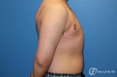 Denver FTM Top Surgery 5089 - After Image 3
