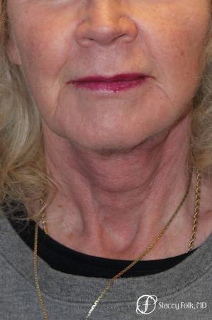 Denver Facial Rejuvenation Face lift, Fat Injections, and Laser Resurfacing 7131 - After Image 3